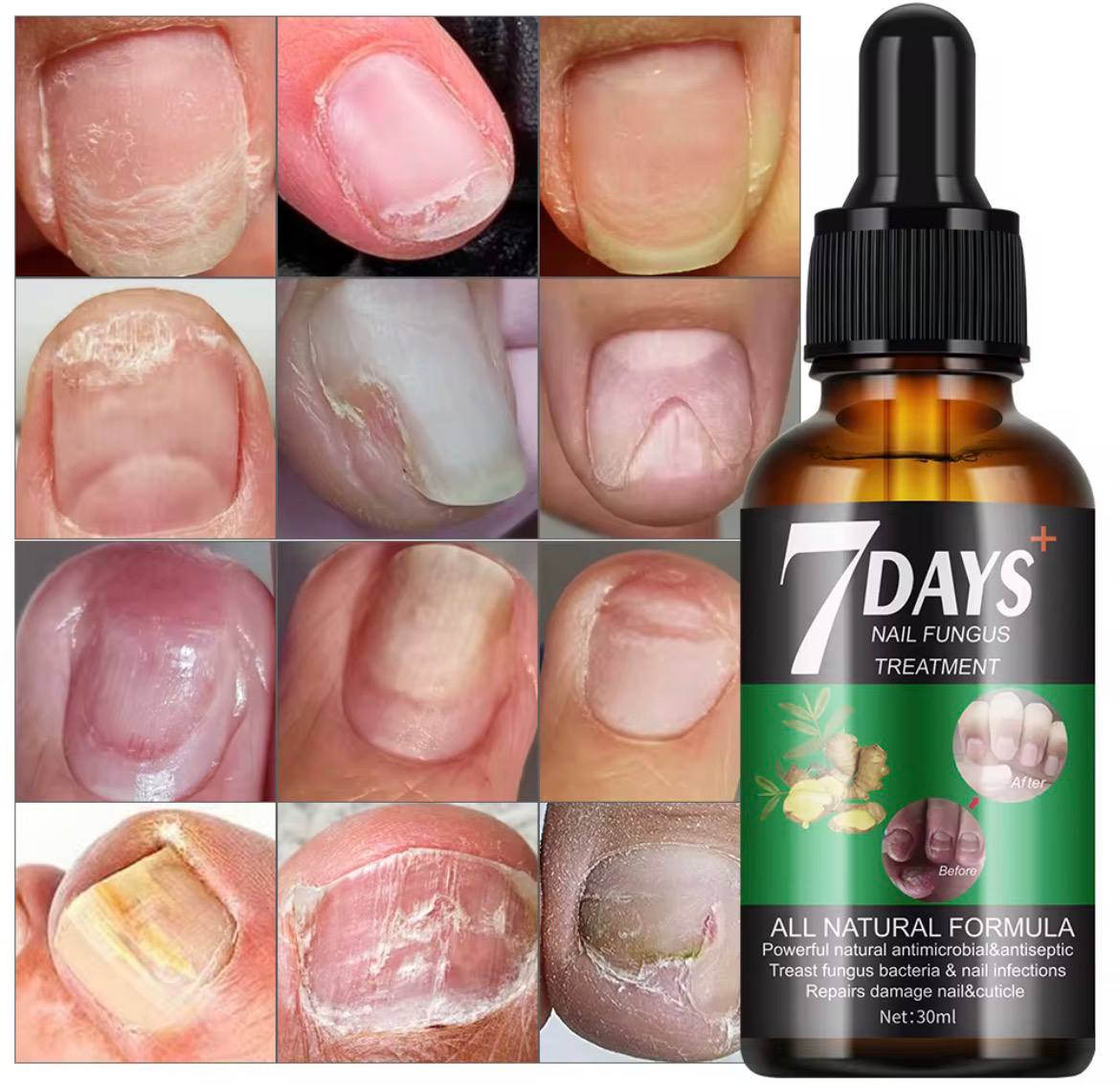 💅 𝗚𝗲𝗹 𝗔𝗻𝘁𝗶-𝗠𝘆𝗰𝗼𝘀𝗲 𝗢𝗻𝗴𝗹𝗲𝘀 – 𝚁é𝚙𝚊𝚛𝚎 𝚎𝚗 𝚙𝚛𝚘𝚏𝚘𝚗𝚍𝚎𝚞𝚛. 𝙿𝚛𝚘𝚝è𝚐𝚎 𝚍𝚞𝚛𝚊𝚋𝚕𝚎𝚖𝚎𝚗𝚝.